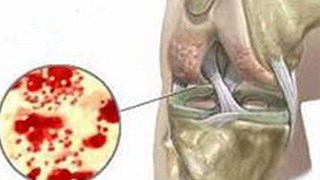 Viêm khớp nhiễm trùng sinh mủ - Hình ảnh minh họa